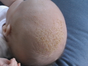 Baby with cradle cap that looks like dandruff