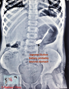 Button battery Ingestion