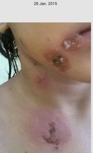 Nasty scabbing in a child suffering from chicken pox