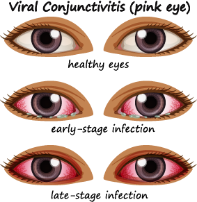 Stages of conjunctivitis