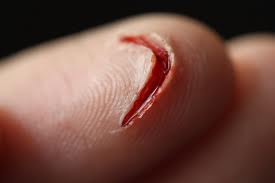 cut cuts burns bruises tetanus open wounds does finger chemical minor aid child ocean shot need injury swim when visitors