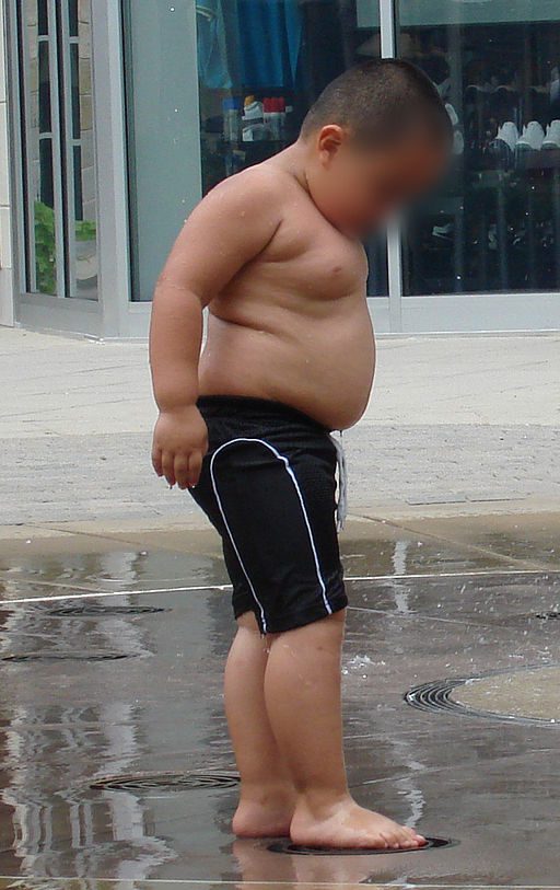 Obese child - commonest lifestyle issue in children today