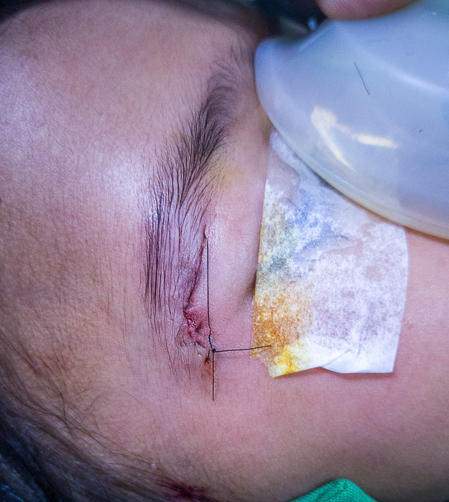 Same wound sutured under anesthesia