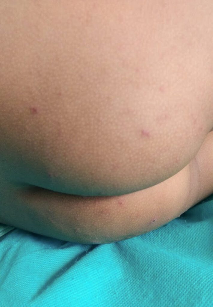 HFMD rash on child's buttocks — scattered red spots, clinical photo Nathani Clinic